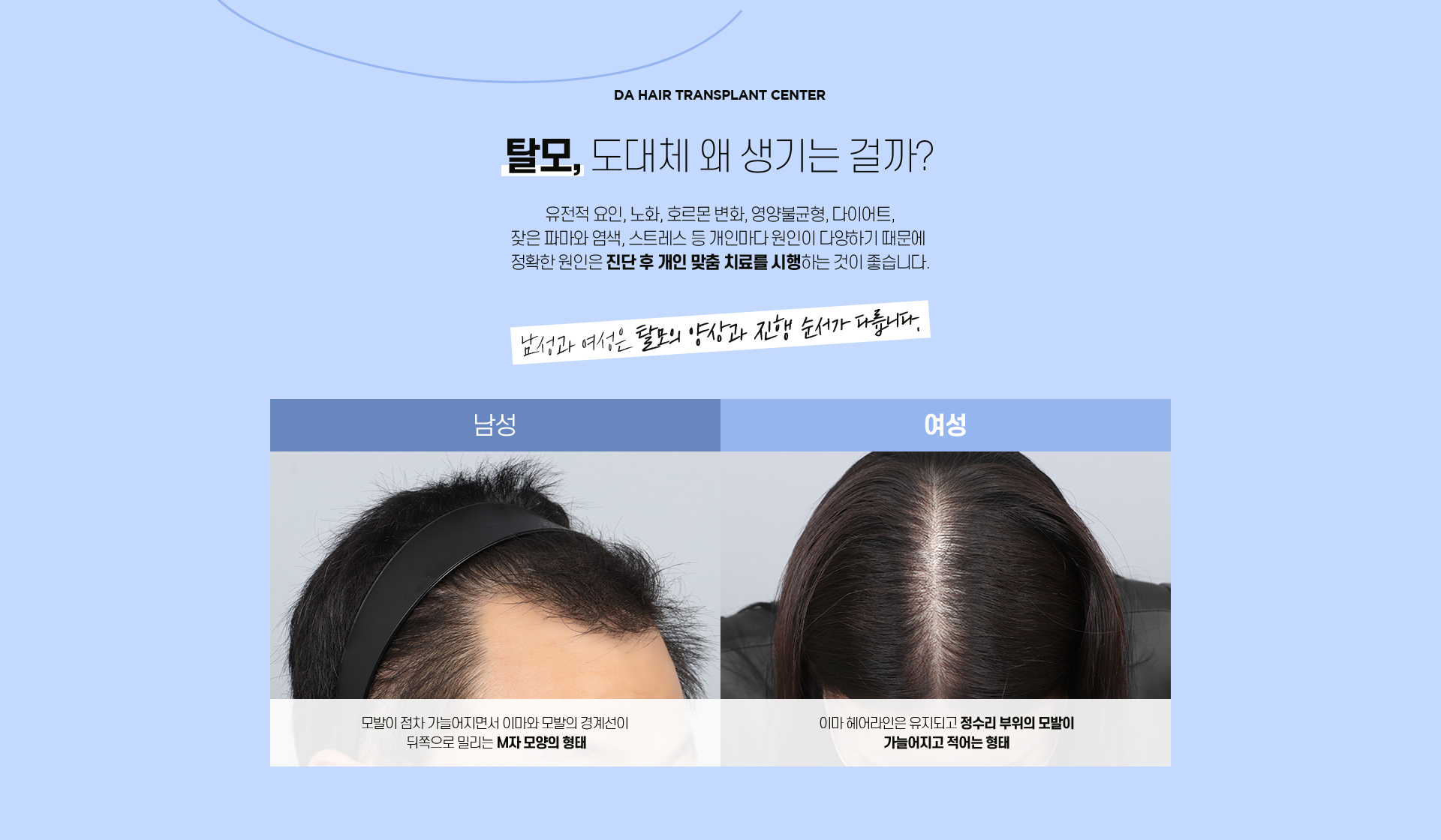 자가탈모 테스트