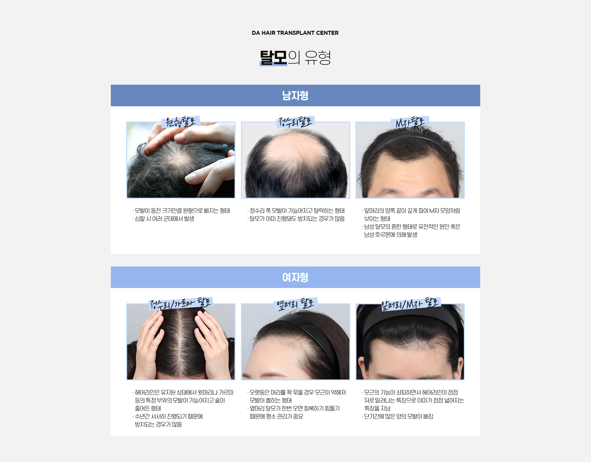 자가탈모 테스트