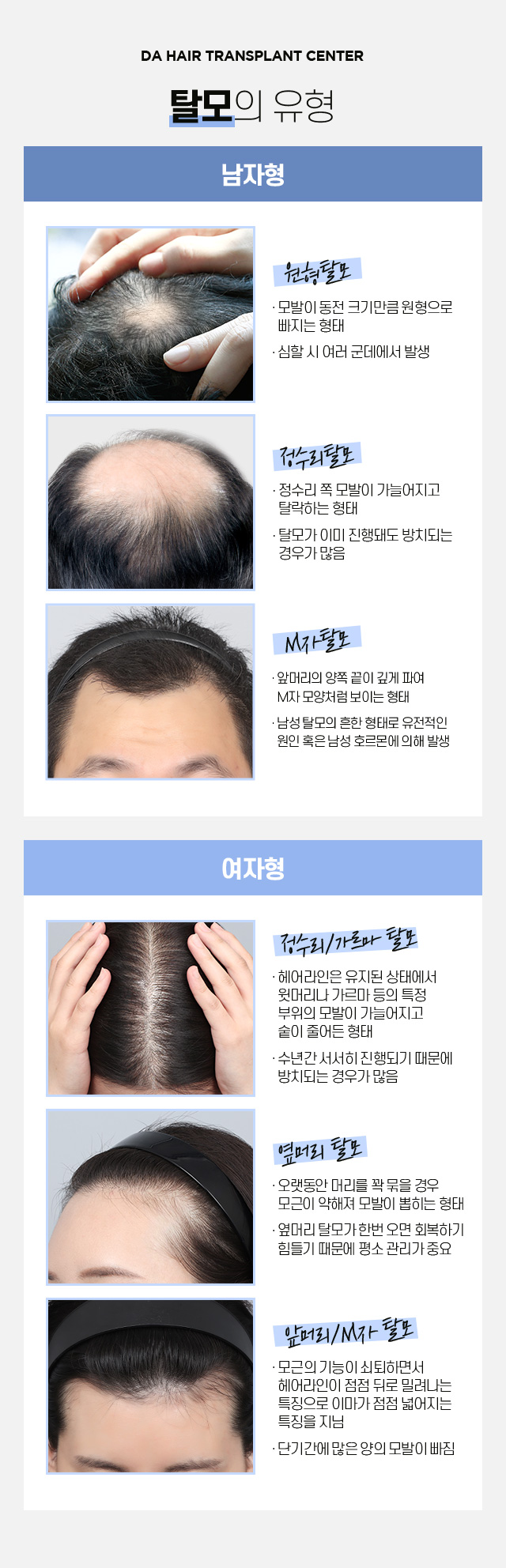 자가탈모 테스트