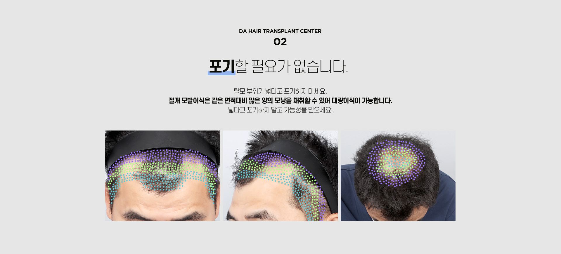절개 모발이식
