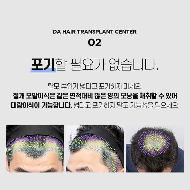 절개 모발이식