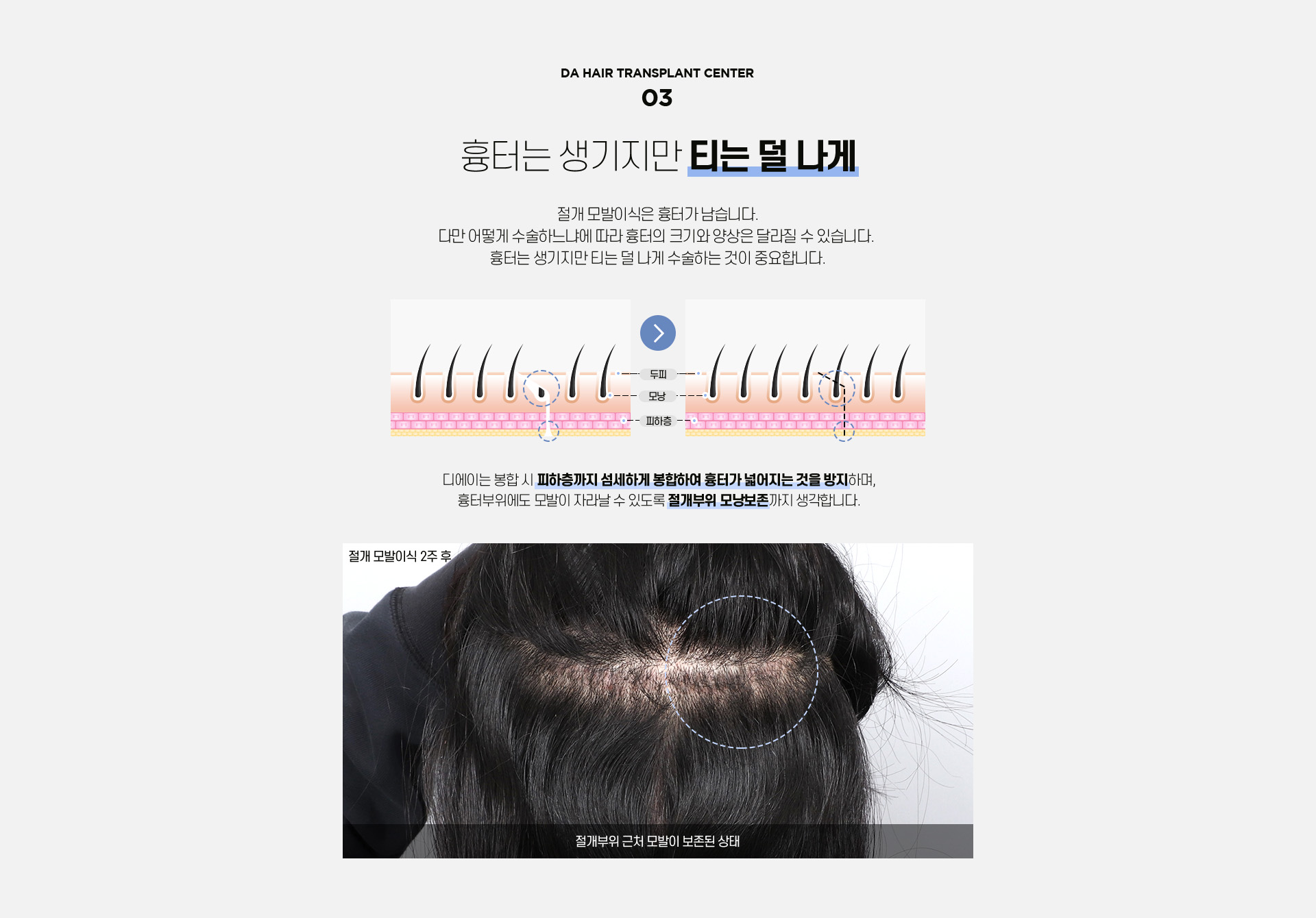절개 모발이식