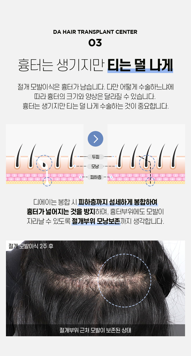 절개 모발이식