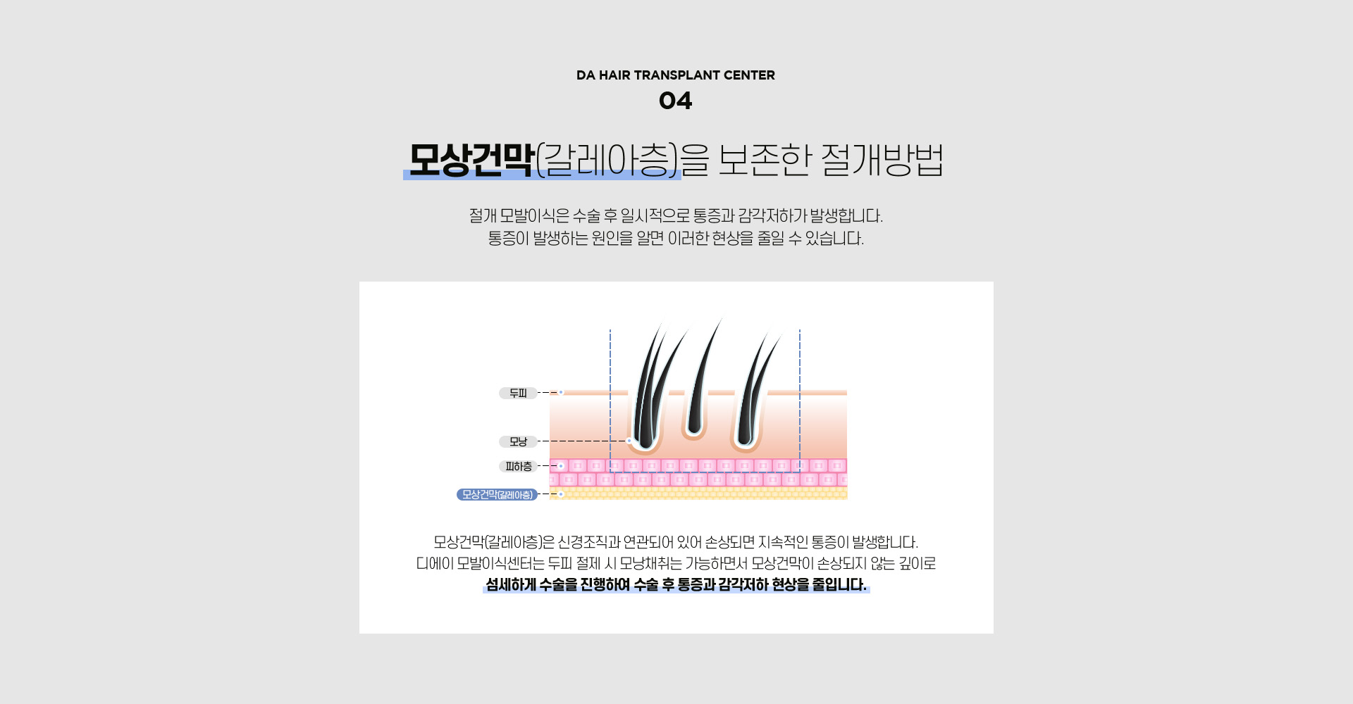 절개 모발이식