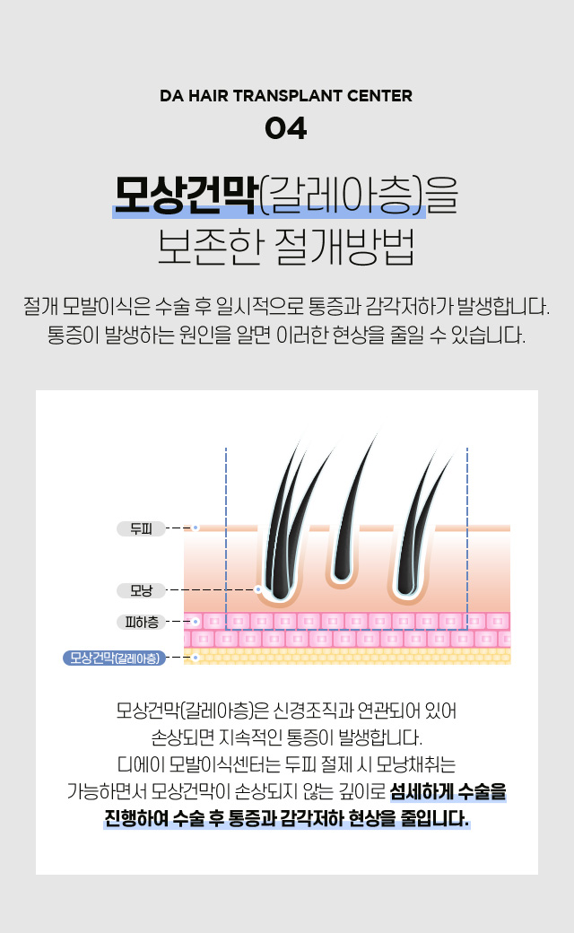 절개 모발이식