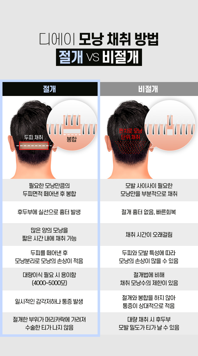 절개 모발이식