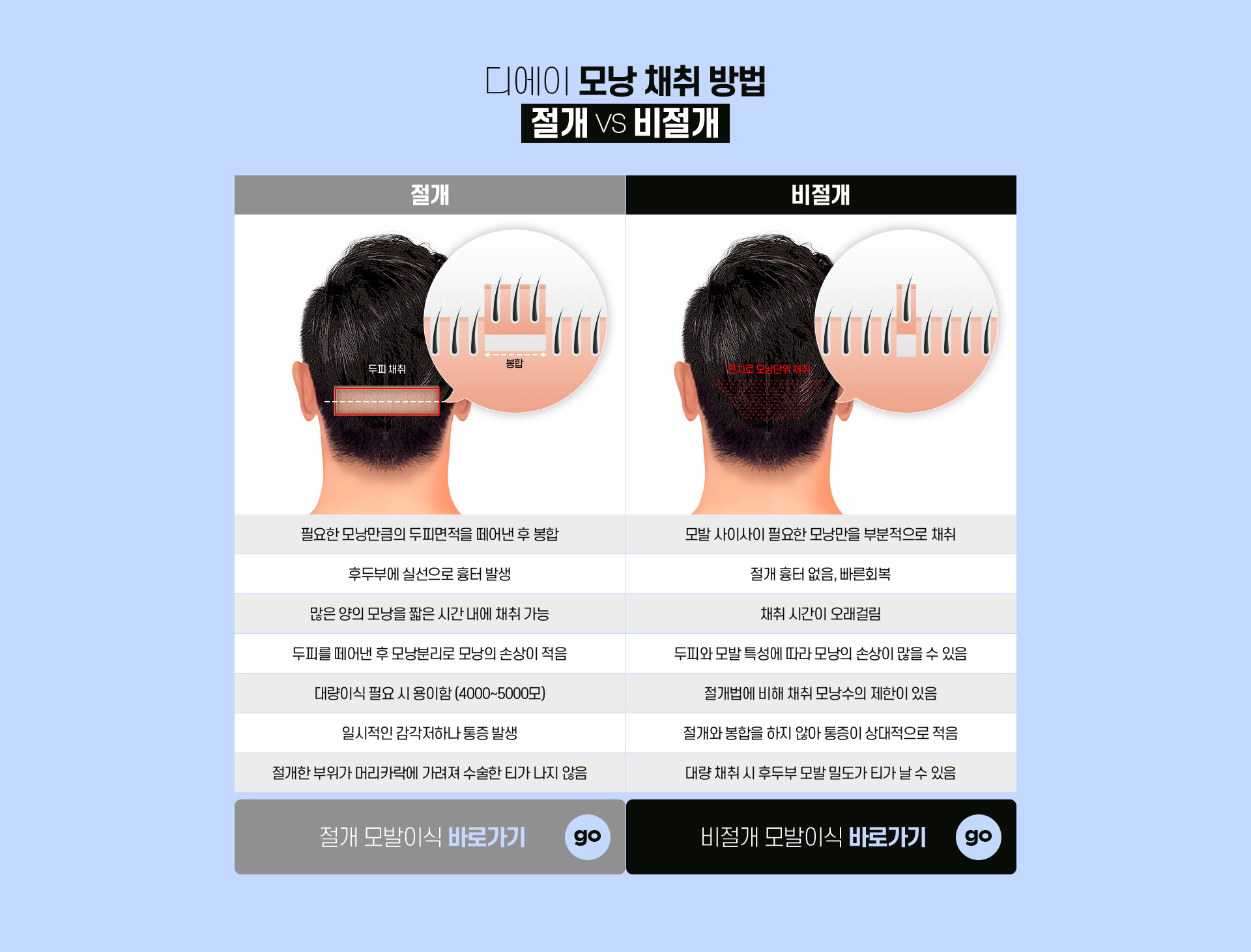 대량 모발이식