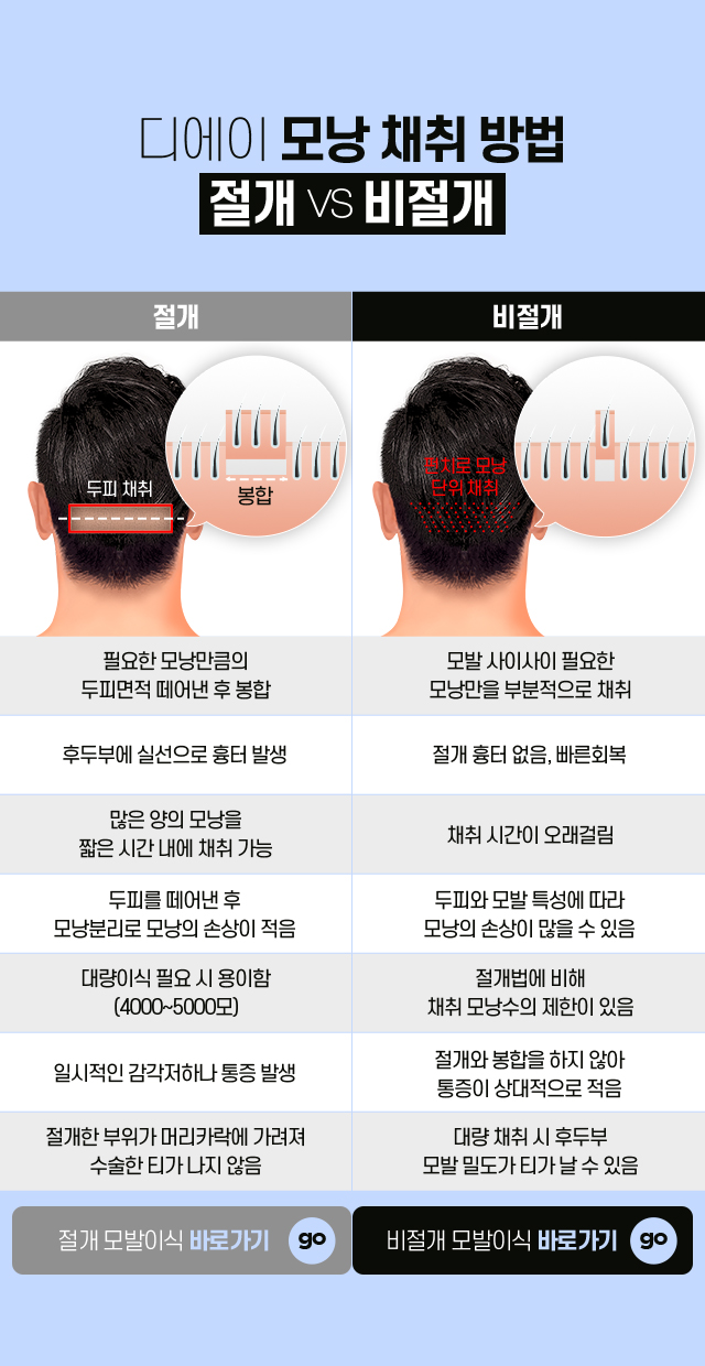 대량 모발이식