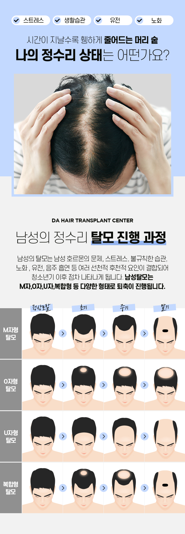 남자 정수리 모발이식