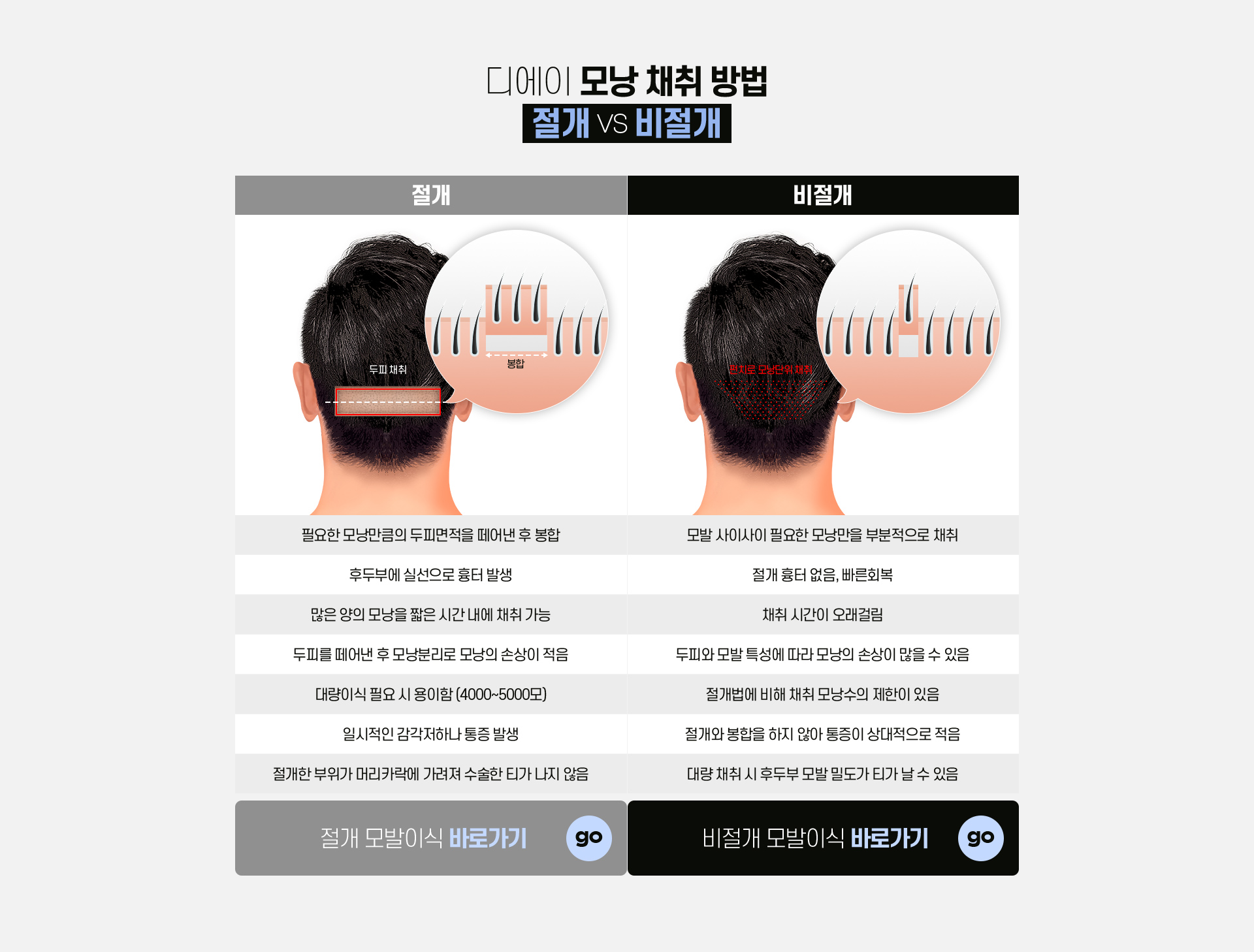 남자 정수리 모발이식