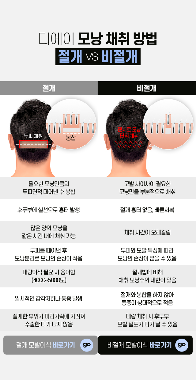 남자 정수리 모발이식