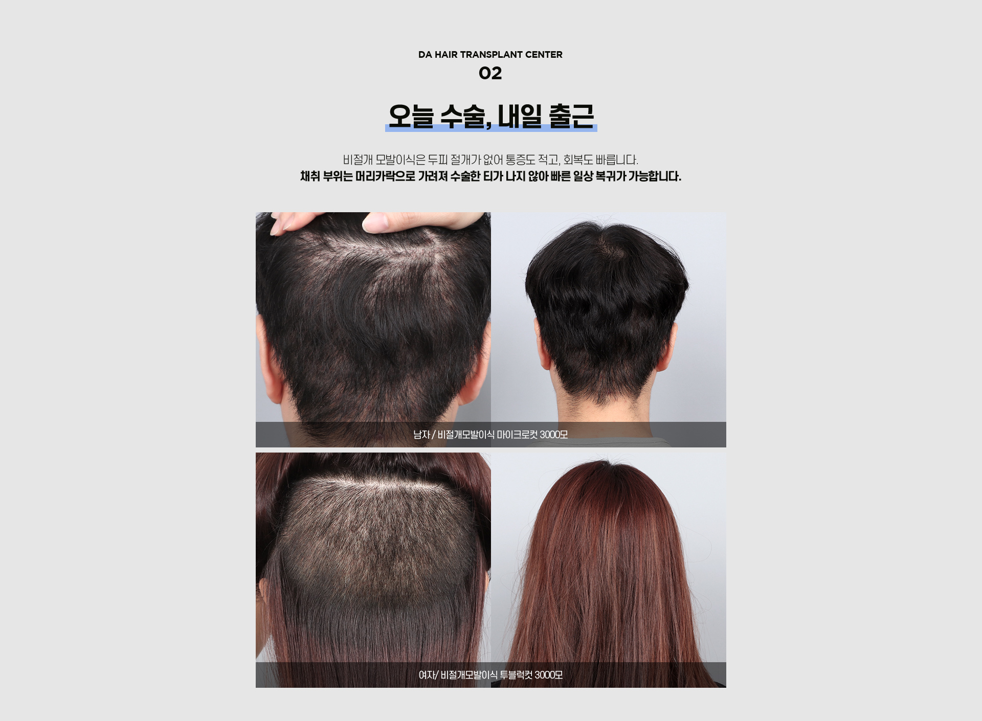 비절개 모발이식