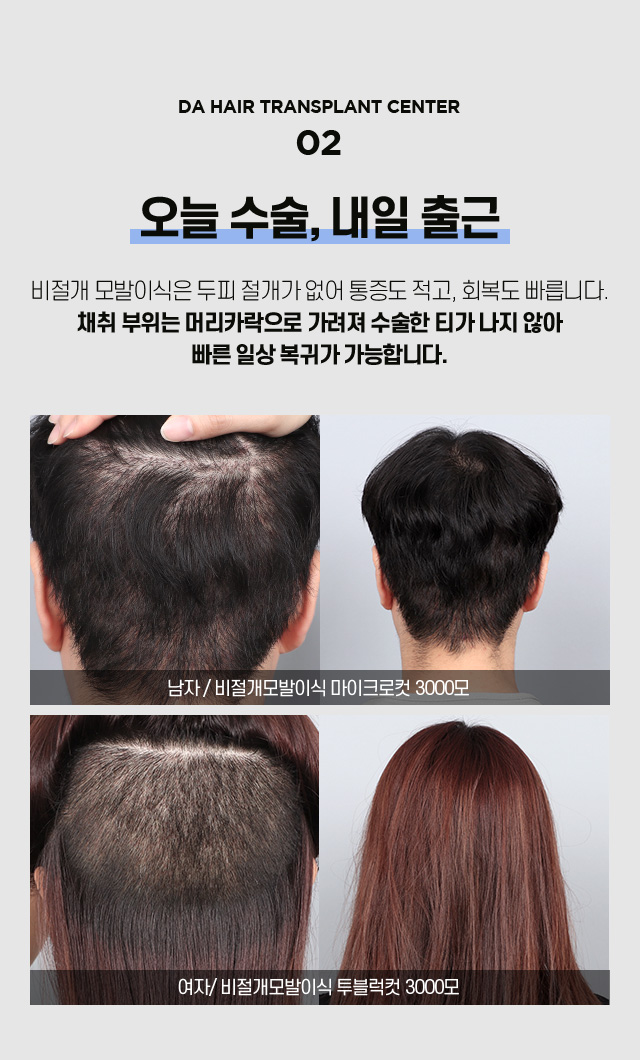 비절개 모발이식