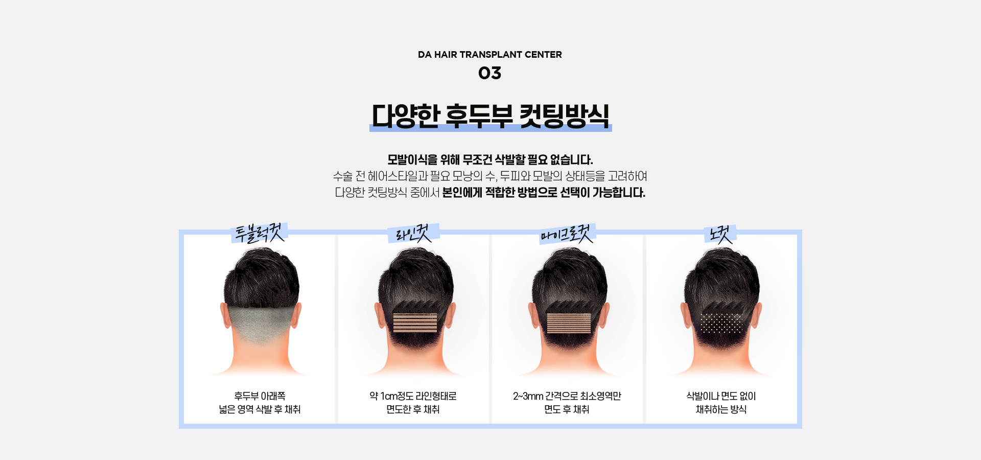 비절개 모발이식