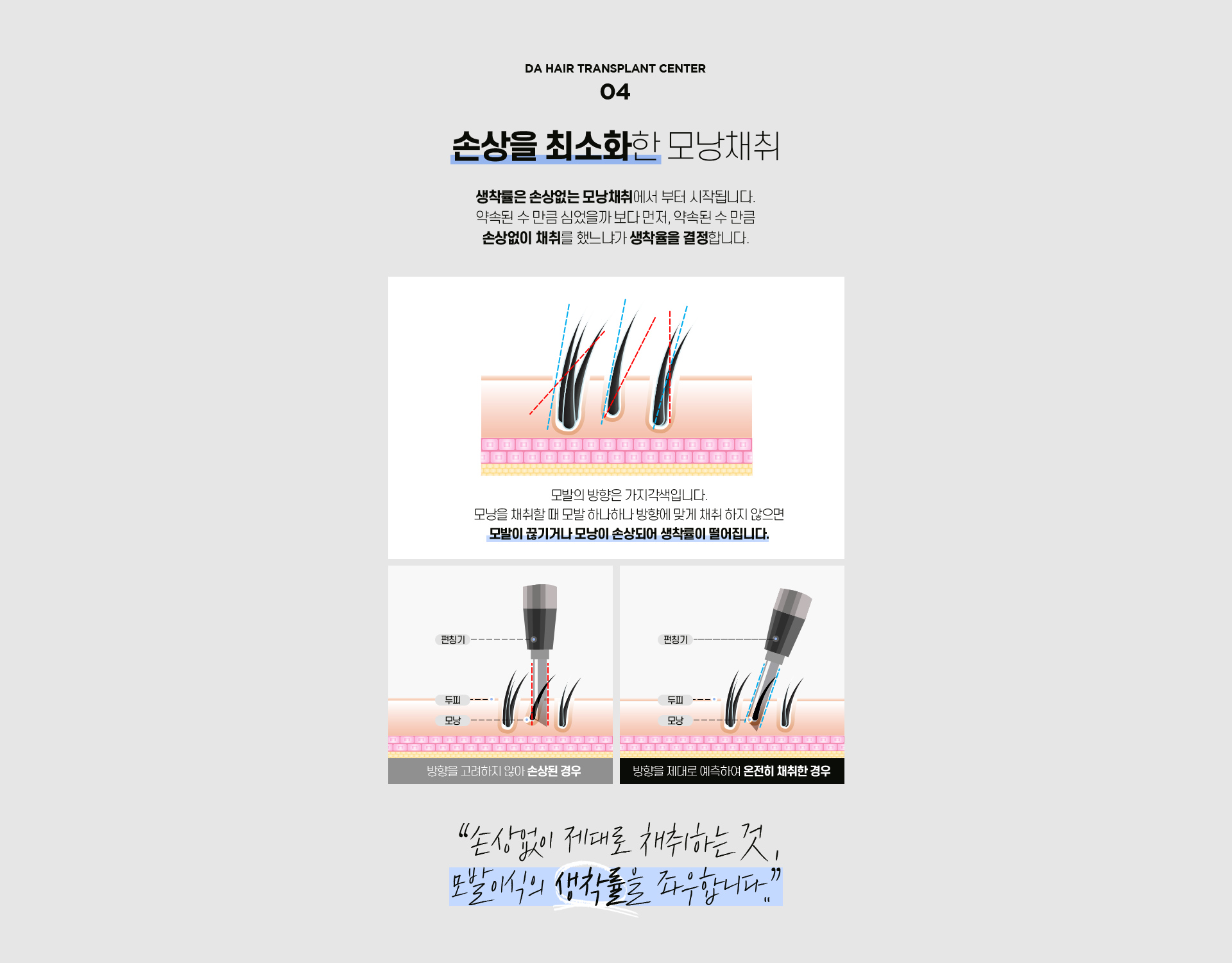 비절개 모발이식