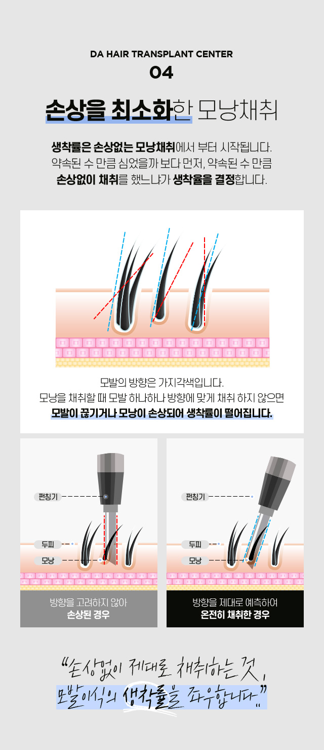 비절개 모발이식