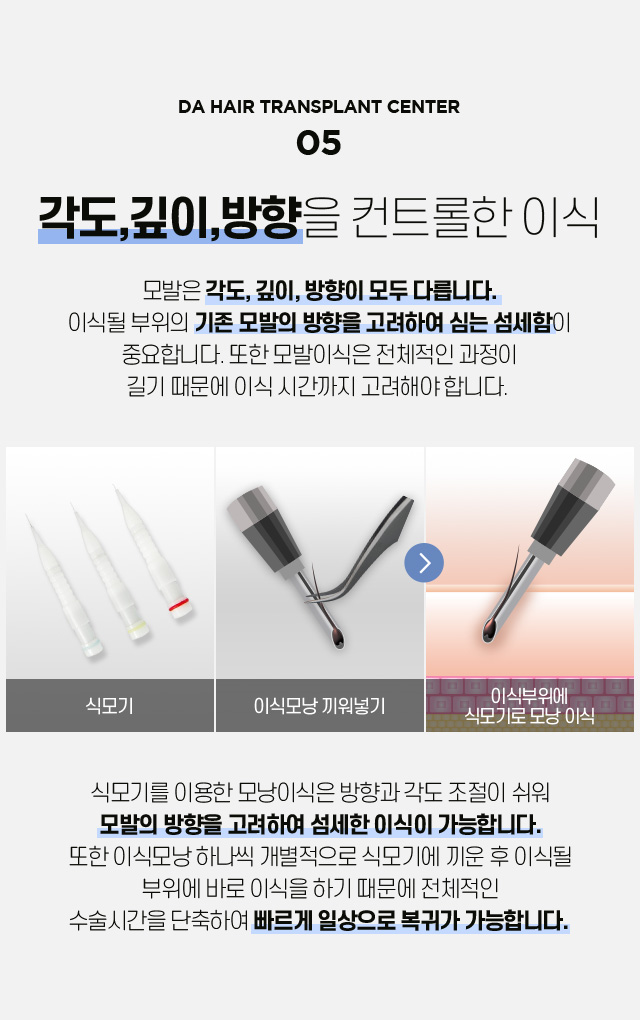 비절개 모발이식