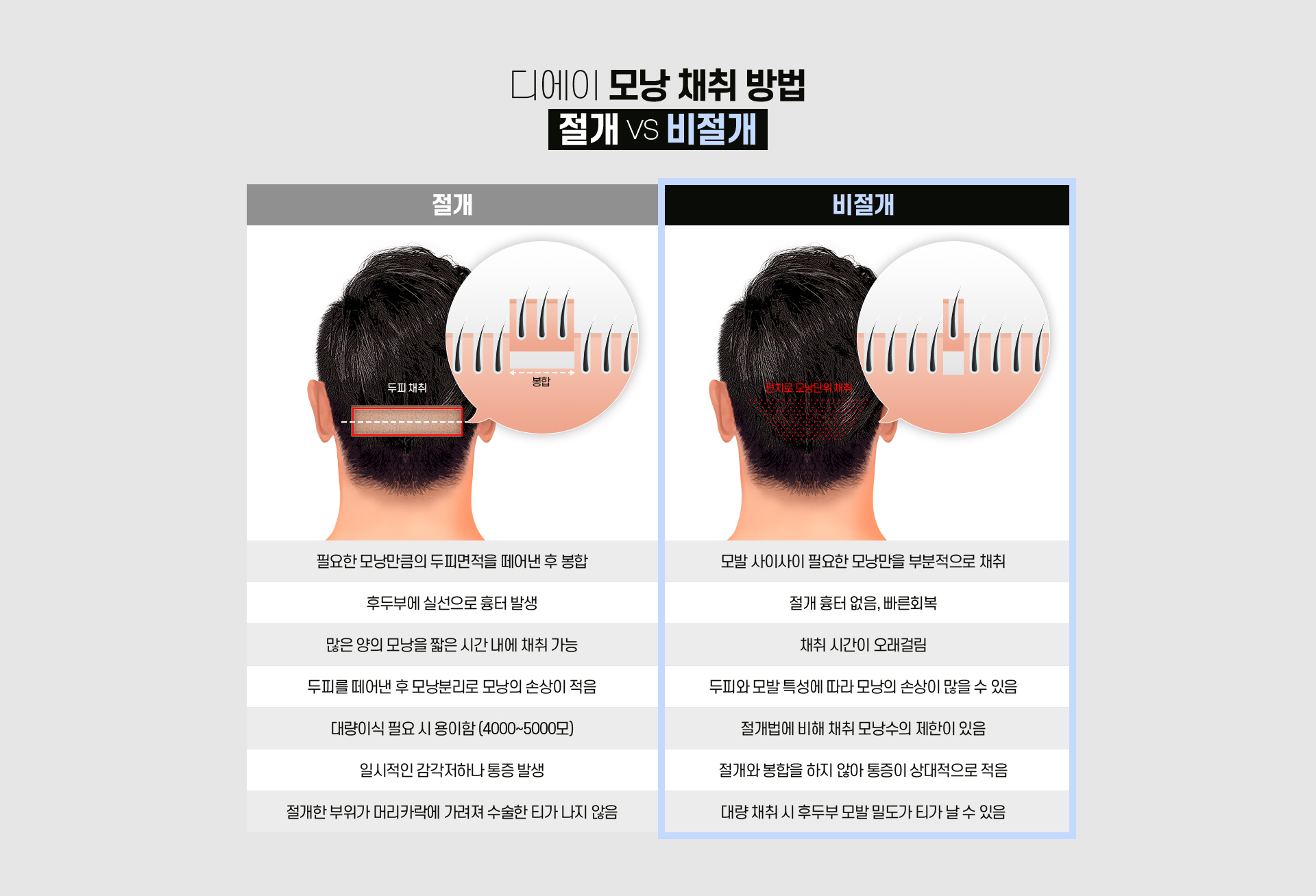 비절개 모발이식