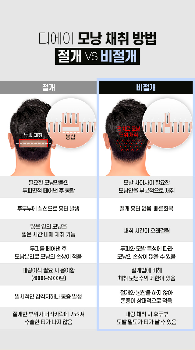 비절개 모발이식