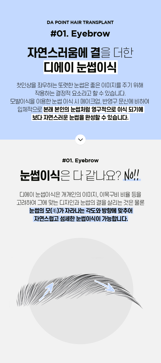 포인트 모발이식