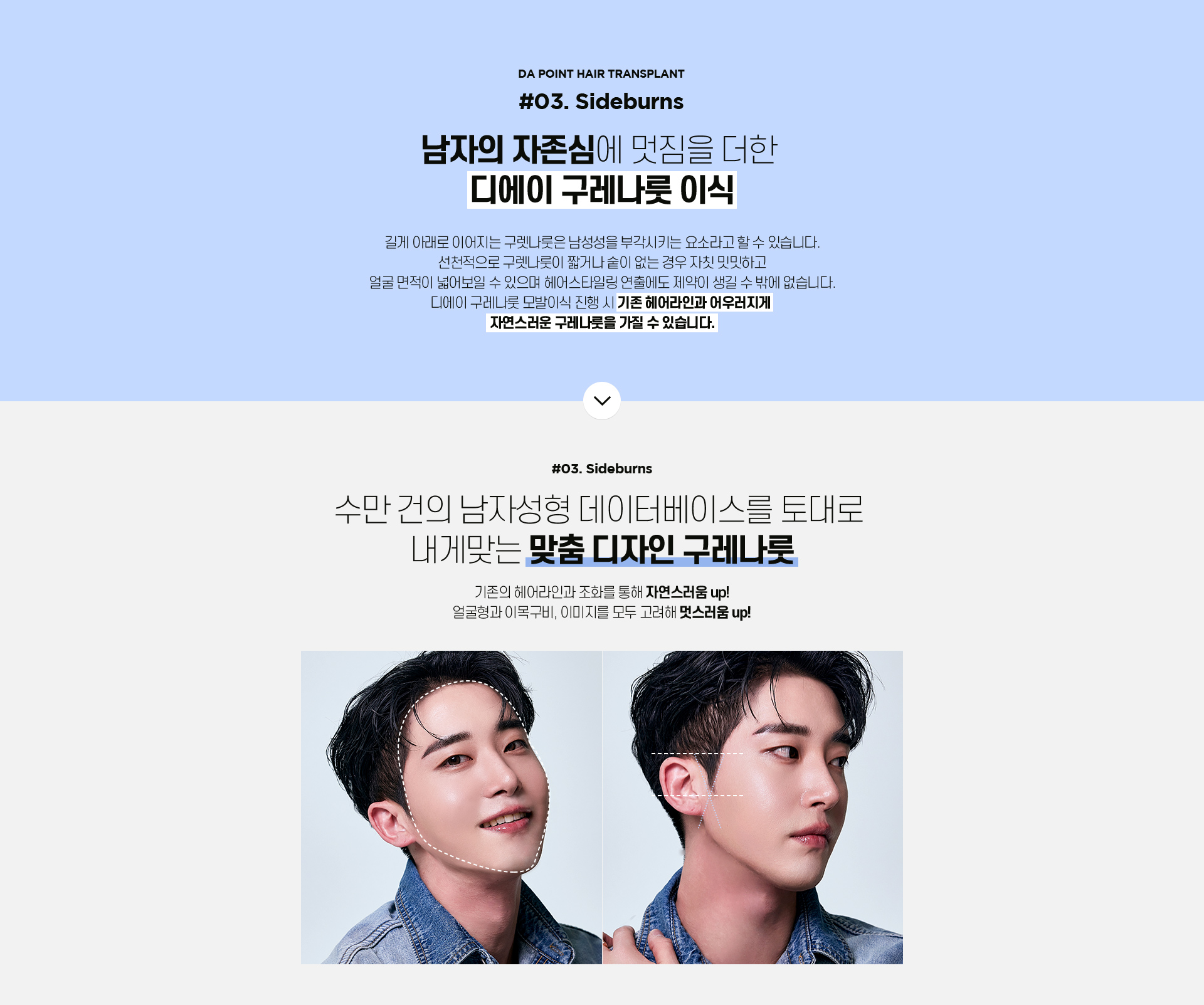 포인트 모발이식