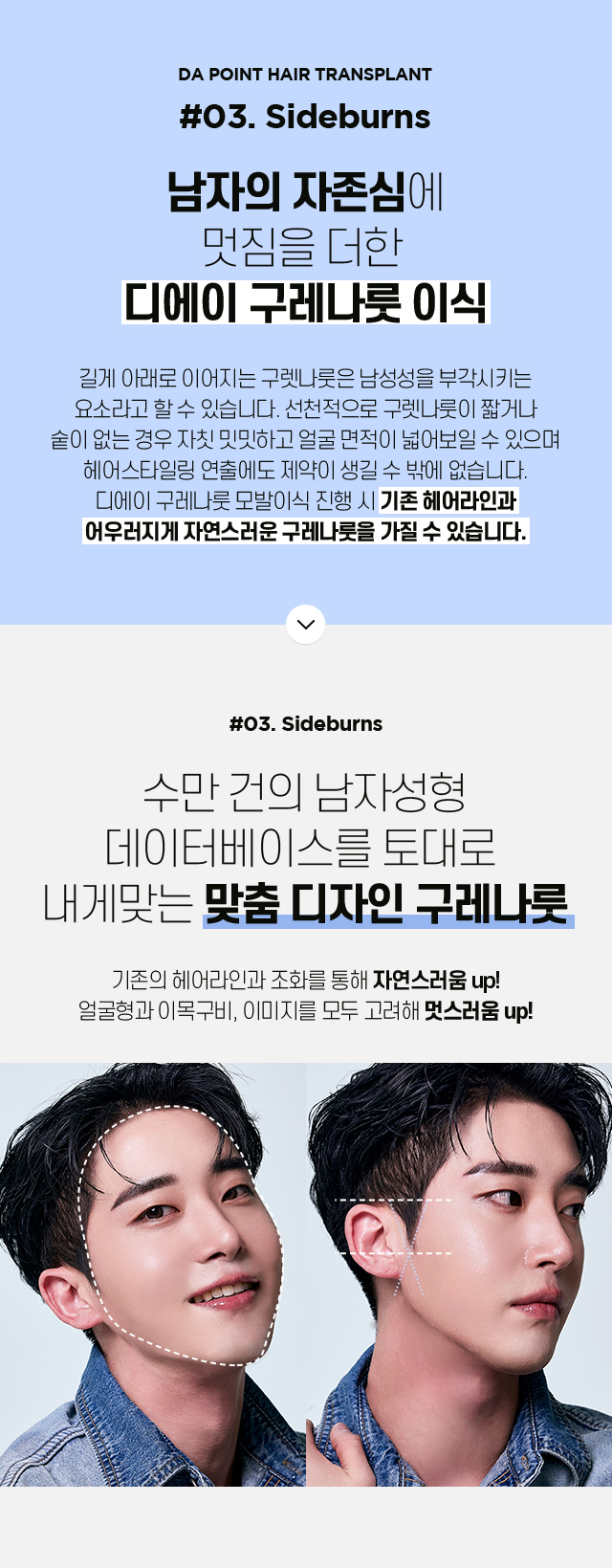 포인트 모발이식