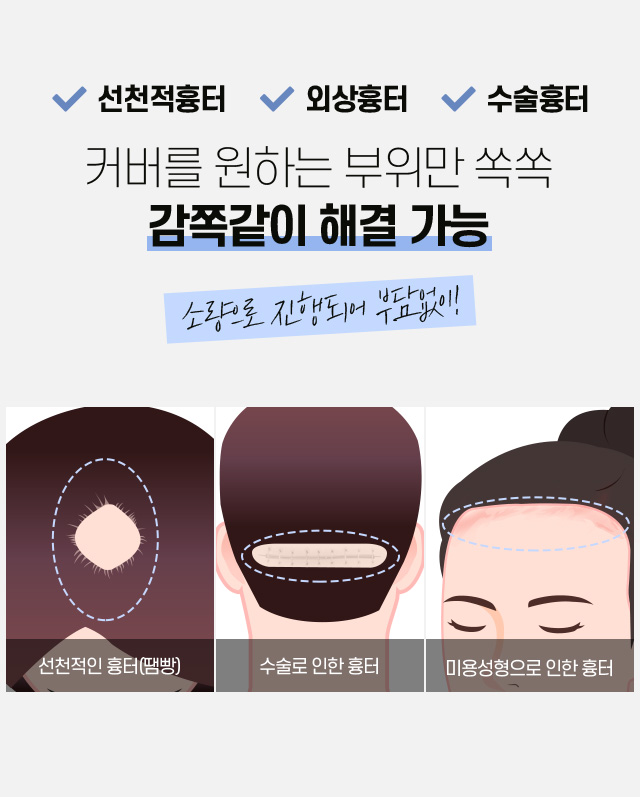 흉터 모발이식